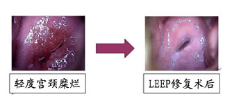 轻度宫颈糜烂的症状有哪些